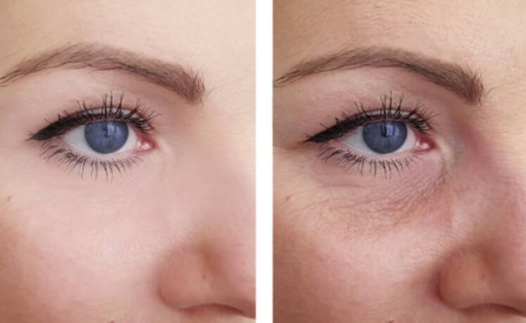 pred a po plazmovom omladení očného okolia