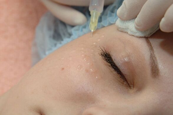 Mezoterapia - injekčná metóda omladenia pokožky tváre