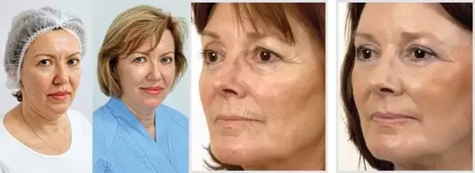 Výsledkom omladenia pokožky tváre laserom je redukcia vrások