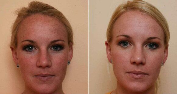 pred a po omladení pokožky tváre laserom