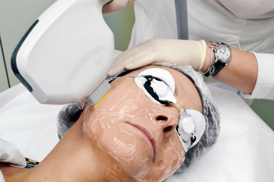 laserové omladenie pokožky tváre